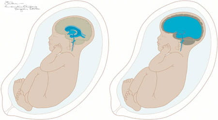 An illustration of hydrocephalus.